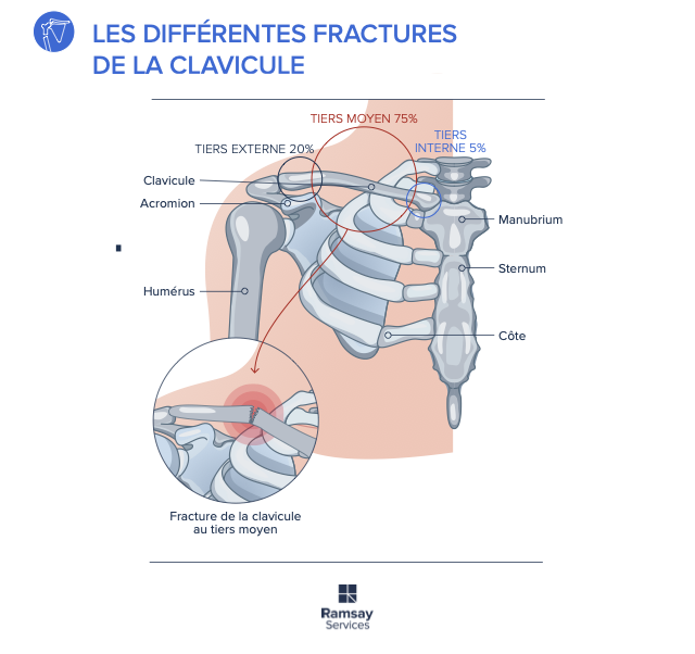 Fracture ou fissure de la clavicule un traumatisme fréquent à ne pas négliger